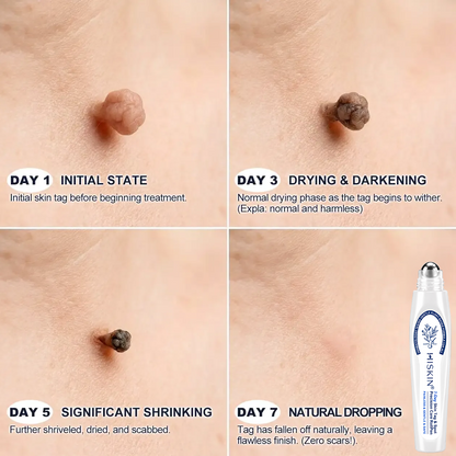 𝐇𝐈𝐒𝐊𝐈𝐍®🎉 𝟕-𝐃𝒂𝘆 𝐒𝗸𝐢𝐧 𝐓𝒂𝗴 & 𝐒𝐩𝙤𝐭 𝐄𝐫𝒂𝐬𝙚𝐫 Painless & Scar-Free Advanced Imperfection Removal Rollerball Pen (Copy)