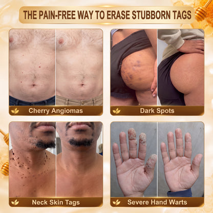 ✨Hiskin ®MULTI-CONCERN SKIN REPAIR BEE VENOM MICRONEEDLE PATCHES